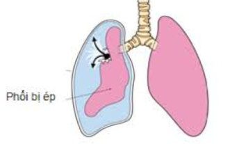 Tràn khí màng phổi, tràn dịch màng phổi